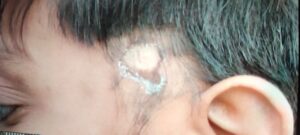 हैवान शिक्षक के बाल उखाड़ने के बाद की तस्वीर